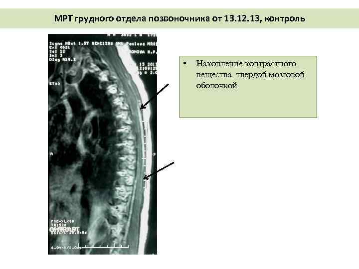 Мрт грудного позвоночника. Мрт образование грудного отдела позвоночника. Мрт грудного отдела норма. Мрт грудного отдела позвоночника с контрастным. Линейные томограммы грудного отдела позвоночника.