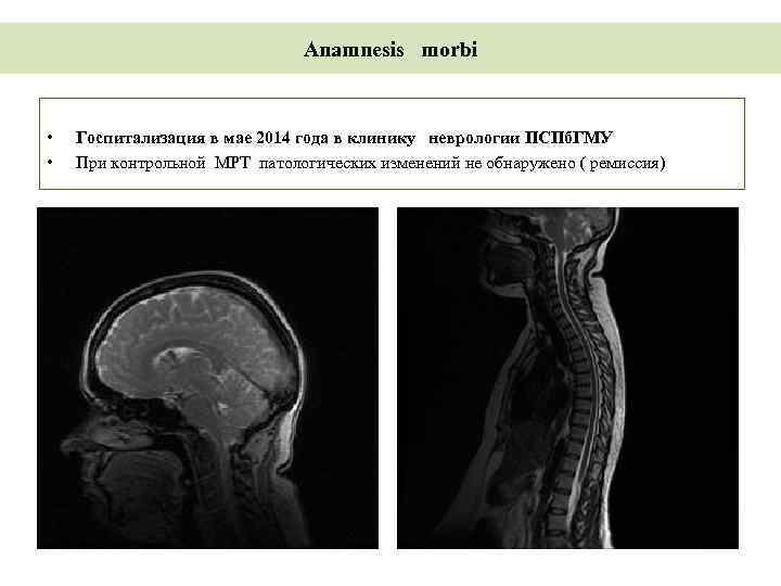 Anamnesis morbi • • Госпитализация в мае 2014 года в клинику неврологии ПСПб. ГМУ