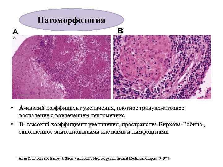 Патоморфология А в • А-низкий коэффициент увеличения, плотное гранулематозное воспаление с вовлечением лептоменикс •