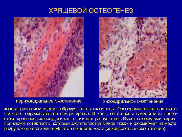 Незавершенный остеогенез