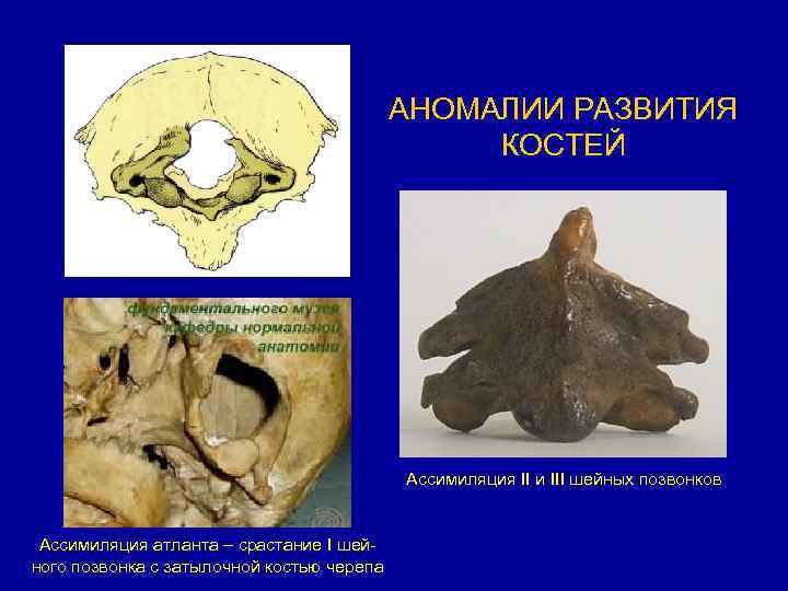 АНОМАЛИИ РАЗВИТИЯ КОСТЕЙ Ассимиляция II и III шейных позвонков Ассимиляция атланта – срастание I