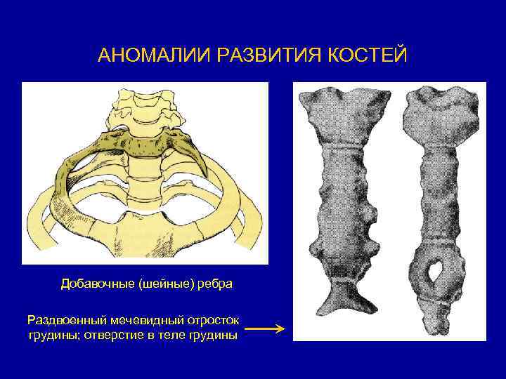 Отросток грудины