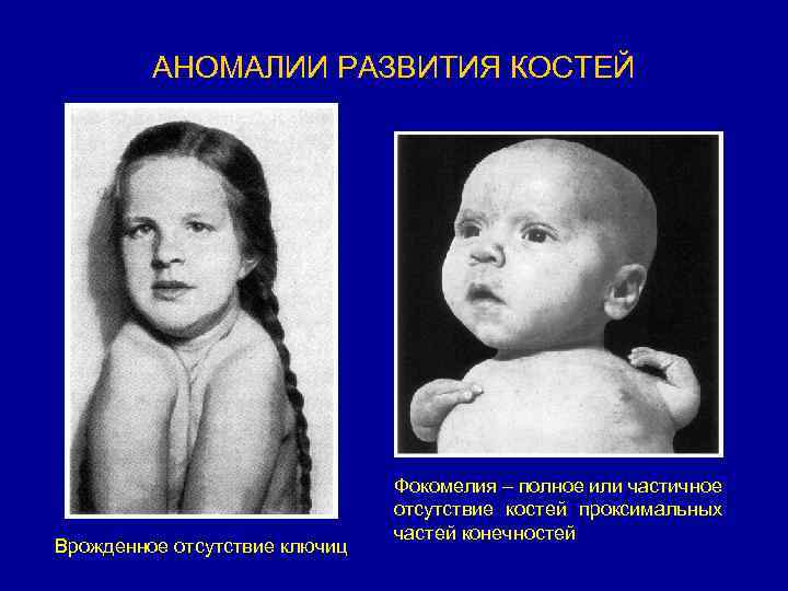 АНОМАЛИИ РАЗВИТИЯ КОСТЕЙ Врожденное отсутствие ключиц Фокомелия – полное или частичное отсутствие костей проксимальных