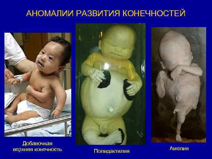 АНОМАЛИИ РАЗВИТИЯ КОНЕЧНОСТЕЙ Добавочная верхняя конечность Полидактилия Амелия 