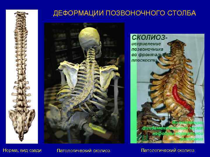 ДЕФОРМАЦИИ ПОЗВОНОЧНОГО СТОЛБА Норма, вид сзади Патологический сколиоз 