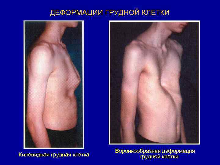 ДЕФОРМАЦИИ ГРУДНОЙ КЛЕТКИ Килевидная грудная клетка Воронкообразная деформация грудной клетки 