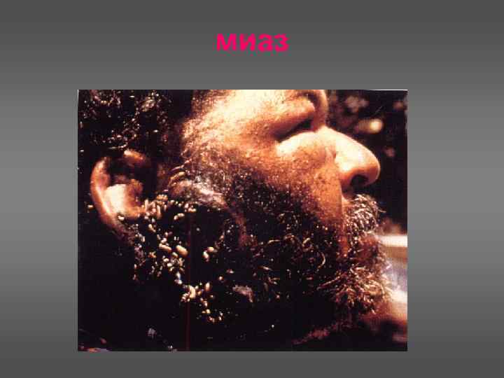миаз 