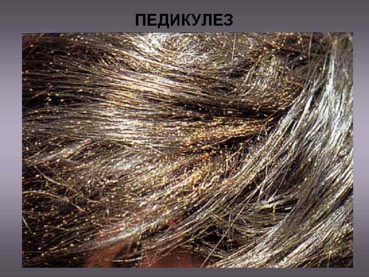 ПЕДИКУЛЕЗ 