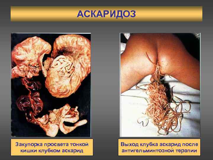 АСКАРИДОЗ Закупорка просвета тонкой кишки клубком аскарид Выход клубка аскарид после антигельминтозной терапии 