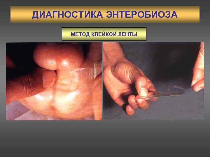 ДИАГНОСТИКА ЭНТЕРОБИОЗА МЕТОД КЛЕЙКОЙ ЛЕНТЫ 