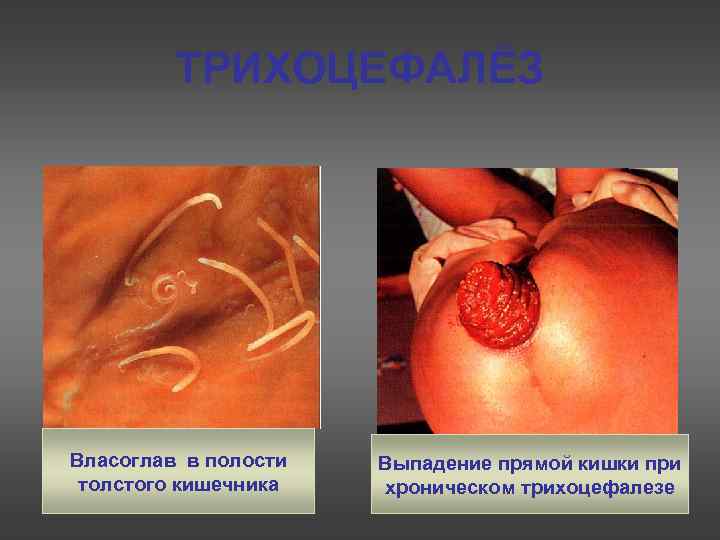 ТРИХОЦЕФАЛЁЗ Власоглав в полости толстого кишечника Выпадение прямой кишки при хроническом трихоцефалезе 