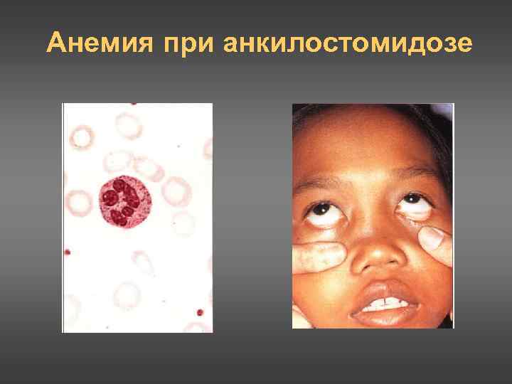 Анемия при анкилостомидозе 