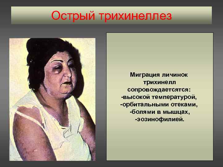 Острый трихинеллез Миграция личинок трихинелл сопровождаетсятся: -высокой температурой, -орбитальными отеками, -болями в мышцах, -эозинофилией.