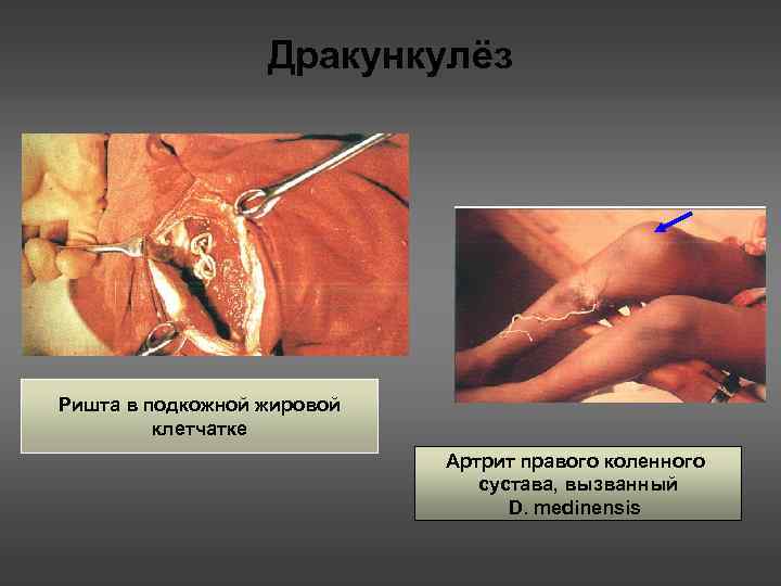 Дракункулёз Ришта в подкожной жировой клетчатке Артрит правого коленного сустава, вызванный D. medinensis 
