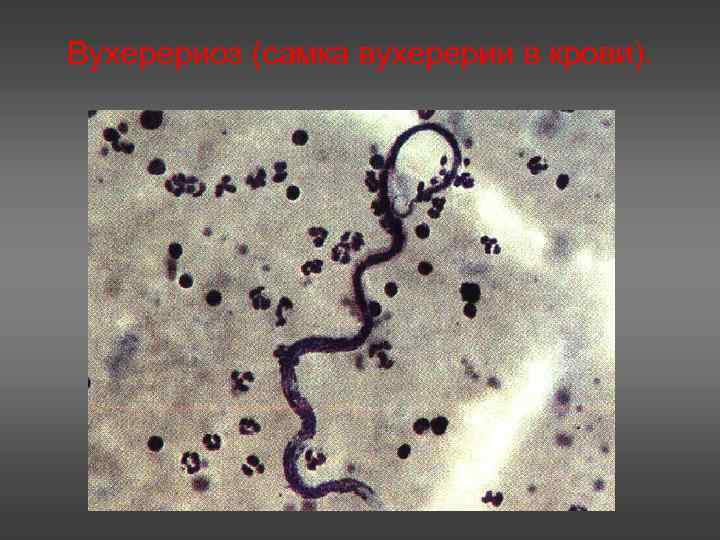 Вухерериоз (самка вухерерии в крови). 