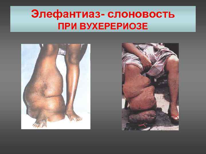 Элефантиаз- слоновость ПРИ ВУХЕРЕРИОЗЕ 