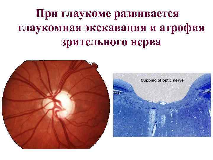 При глаукоме развивается глаукомная экскавация и атрофия зрительного нерва 
