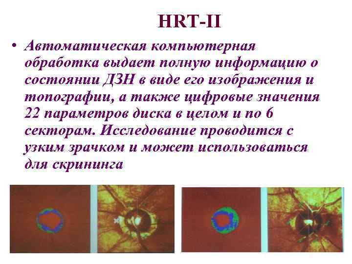 HRT-II • Автоматическая компьютерная обработка выдает полную информацию о состоянии ДЗН в виде его