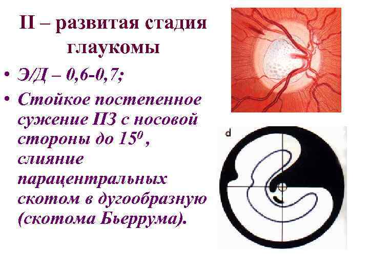 II – развитая стадия глаукомы • Э/Д – 0, 6 -0, 7; • Стойкое