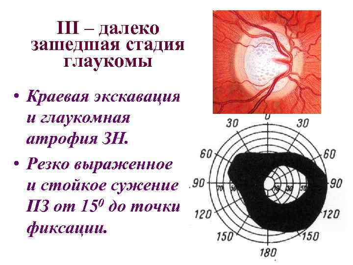 III – далеко зашедшая стадия глаукомы • Краевая экскавация и глаукомная атрофия ЗН. •