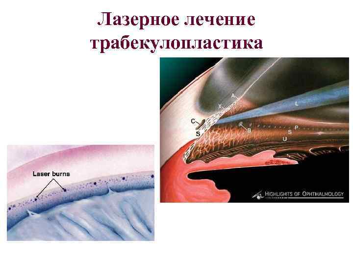 Лазерное лечение трабекулопластика 
