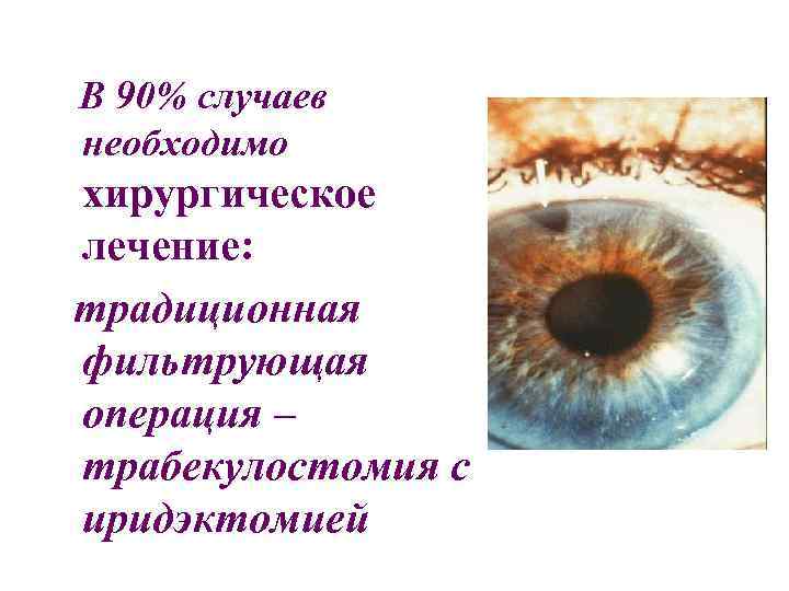 В 90% случаев необходимо хирургическое лечение: традиционная фильтрующая операция – трабекулостомия с иридэктомией 