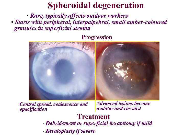 Spheroidal degeneration • Rare, typically affects outdoor workers • Starts with peripheral, interpalpebral, small