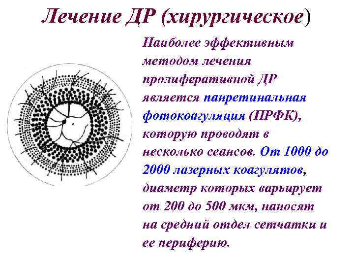 Лечение ДР (хирургическое) Наиболее эффективным методом лечения пролиферативной ДР является панретинальная фотокоагуляция (ПРФК), которую