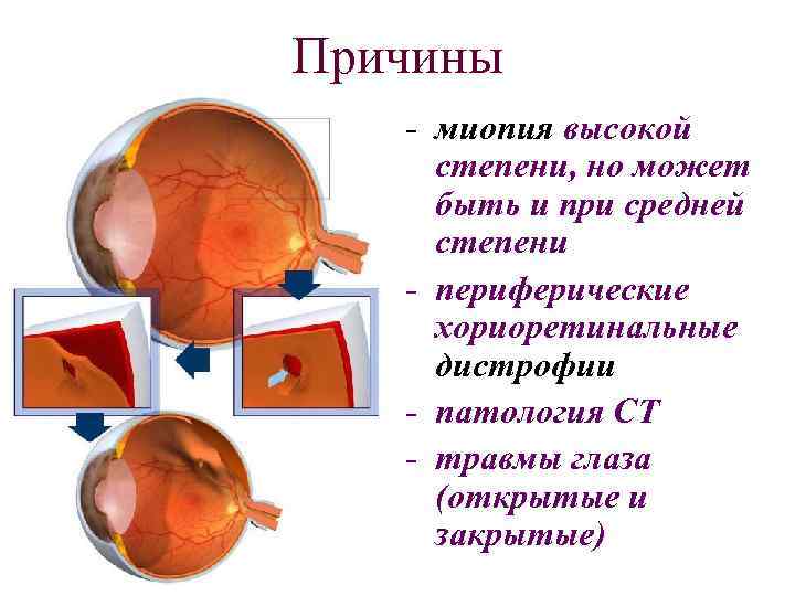 Причины - миопия высокой степени, но может быть и при средней степени - периферические