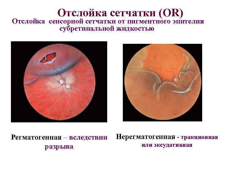 Отслойка сетчатки (OR) Отслойка сенсорной сетчатки от пигментного эпителия субретинальной жидкостью Регматогенная – вследствии