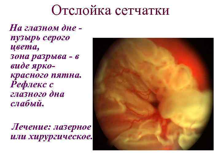 Отслойка сетчатки На глазном дне пузырь серого цвета, зона разрыва - в виде яркокрасного