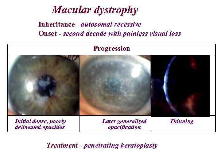 Macular dystrophy Inheritance - autosomal recessive Onset - second decade with painless visual loss