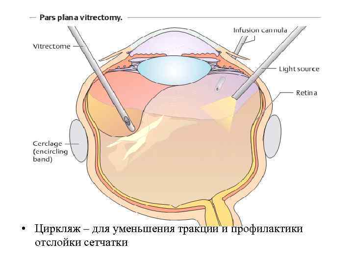 Циркляж