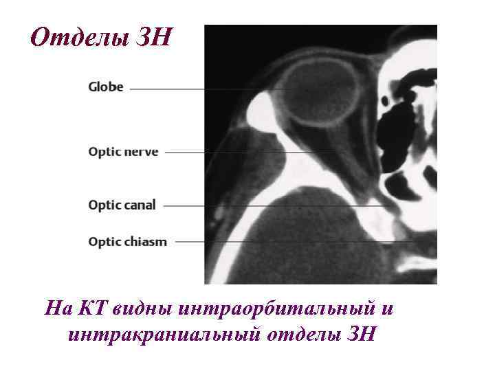 Отделы ЗН На КТ видны интраорбитальный и интракраниальный отделы ЗН 