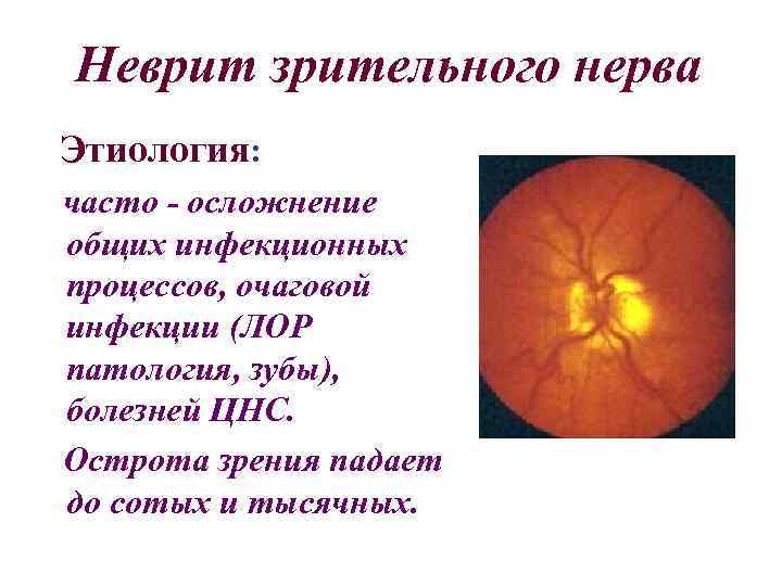 Неврит зрительного нерва Этиология: часто - осложнение общих инфекционных процессов, очаговой инфекции (ЛОР патология,