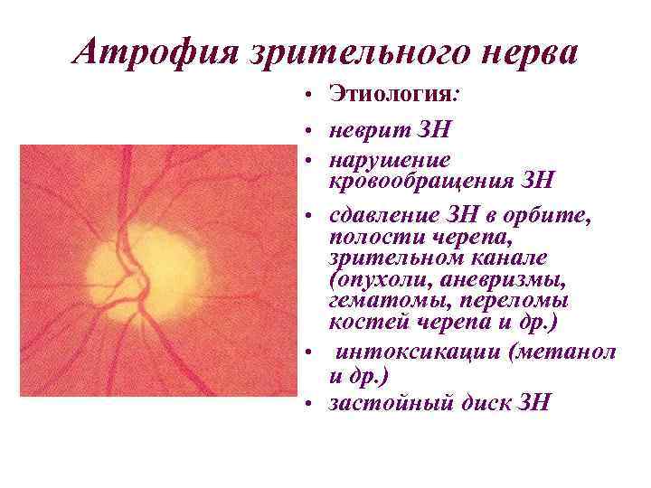 Атрофия зрительного нерва • Этиология: • неврит ЗН • нарушение кровообращения ЗН • сдавление