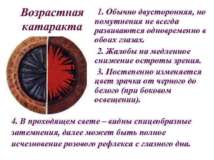 Возрастная катаракта 1. Обычно двусторонняя, но помутнения не всегда развиваются одновременно в обоих глазах.