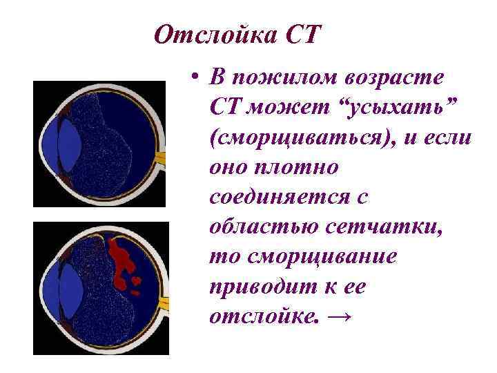 Отслойка СТ • В пожилом возрасте СТ может “усыхать” (сморщиваться), и если оно плотно