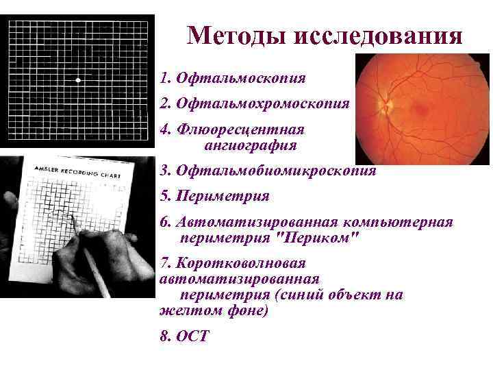 Методы исследования 1. Офтальмоскопия 2. Офтальмохромоскопия 4. Флюоресцентная ангиография 3. Офтальмобиомикроскопия 5. Периметрия 6.