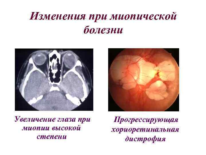 Изменения при миопической болезни Увеличение глаза при миопии высокой степени Прогрессирующая хориоретинальная дистрофия 