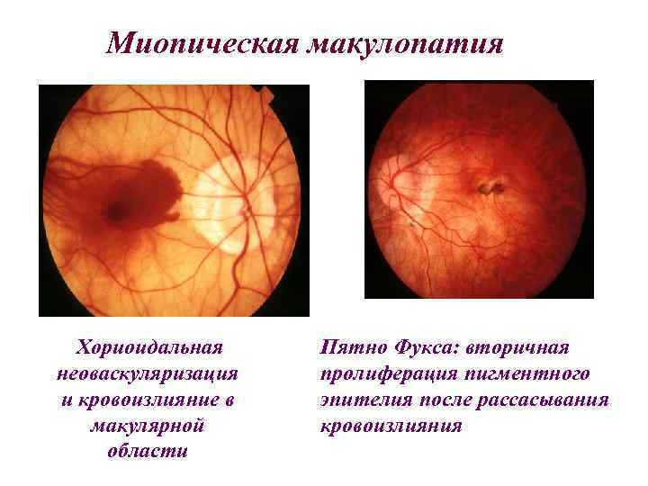 Миопическая макулопатия Хориоидальная неоваскуляризация и кровоизлияние в макулярной области Пятно Фукса: вторичная пролиферация пигментного