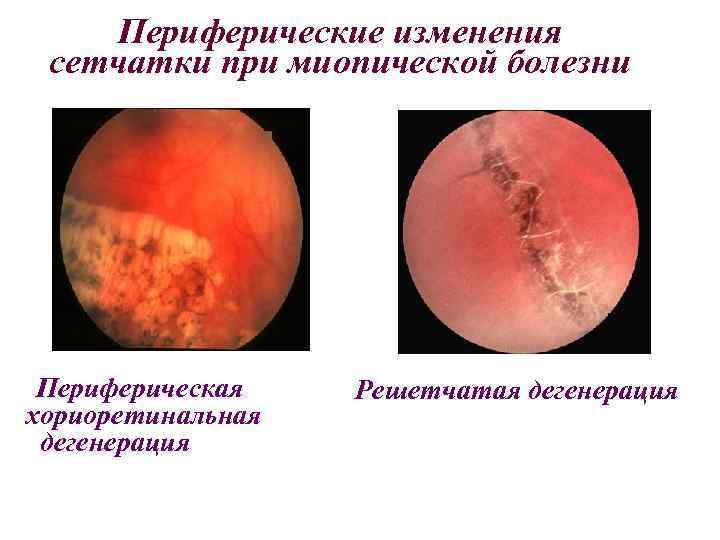 Периферические изменения сетчатки при миопической болезни Периферическая хориоретинальная дегенерация Решетчатая дегенерация 