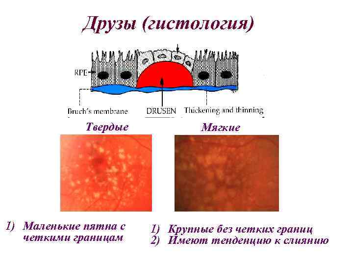 Друзы (гистология) Твердые 1) Маленькие пятна с четкими границам Мягкие 1) Крупные без четких