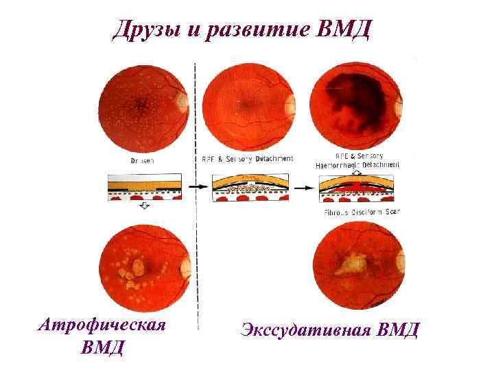 Друзы и развитие ВМД Атрофическая ВМД Экссудативная ВМД 