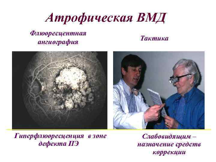 Атрофическая ВМД Флюоресцентная ангиография Гиперфлюоресценция в зоне дефекта ПЭ Тактика Слабовидящим – назначение средств