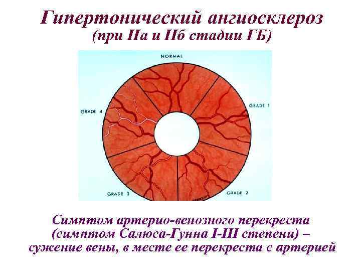 Ангиосклероз сетчатки обоих глаз