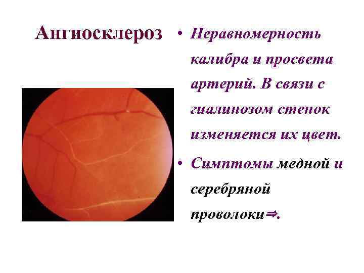 Ангиосклероз • Неравномерность калибра и просвета артерий. В связи с гиалинозом стенок изменяется их