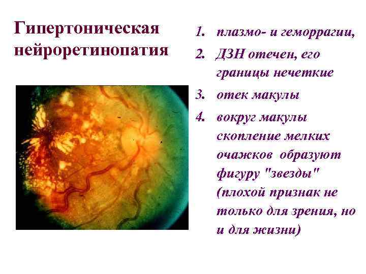 Гипертоническая нейроретинопатия 1. плазмо- и геморрагии, 2. ДЗН отечен, его границы нечеткие 3. отек