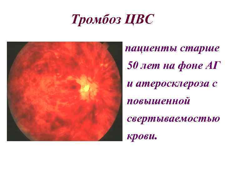 Тромбоз ЦВС пациенты старше 50 лет на фоне АГ и атеросклероза с повышенной свертываемостью