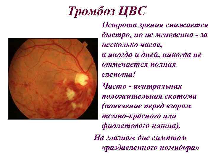 Тромбоз ЦВС Острота зрения снижается быстро, но не мгновенно - за несколько часов, а